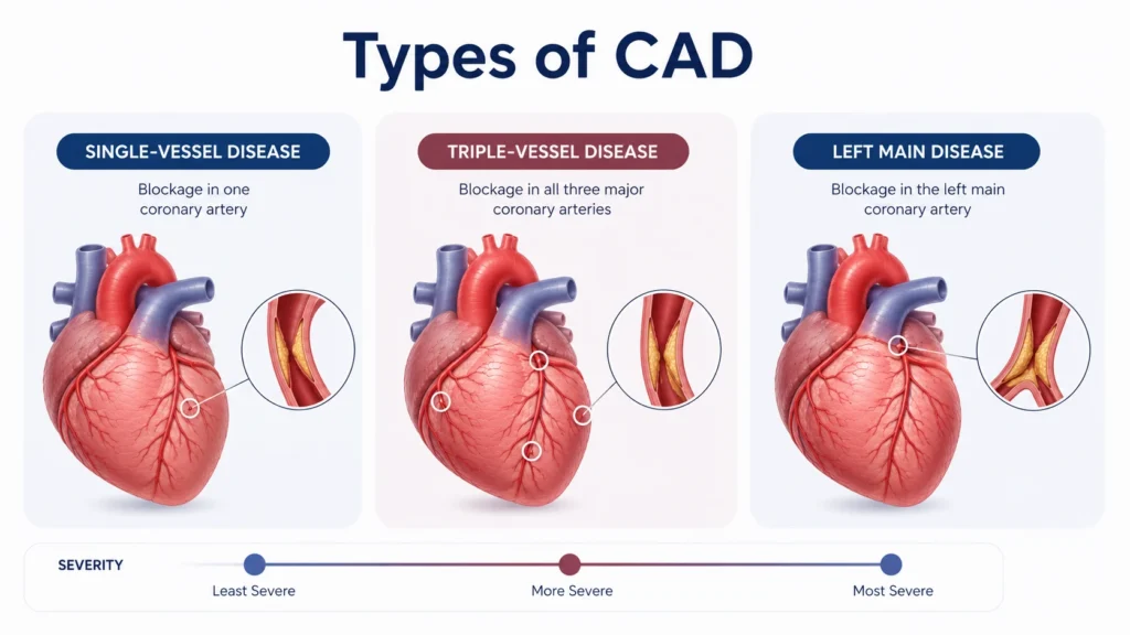 Types Of Coronary Artery Disease. Best doctor for Coronary Artery Disease in Delhi NCR Best surgeon for CABG surgery in Delhi Best treatment for Coronary Artery Disease in Gurgaon Coronary artery blockage treatment without delay Triple vessel coronary artery disease treatment in Delhi NCR Left main coronary artery disease treatment in Gurgaon Minimally invasive CABG surgery in Delhi NCR Off pump bypass surgery specialist in Delhi Experienced coronary bypass surgeon in Gurgaon Advanced coronary artery disease treatment in Delhi NCR Adult coronary artery disease specialist in Delhi Coronary artery disease surgery consultation in Gurgaon